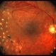 Proliferative Diabetic Retinopathy (PDR), PRP, Regressed NV